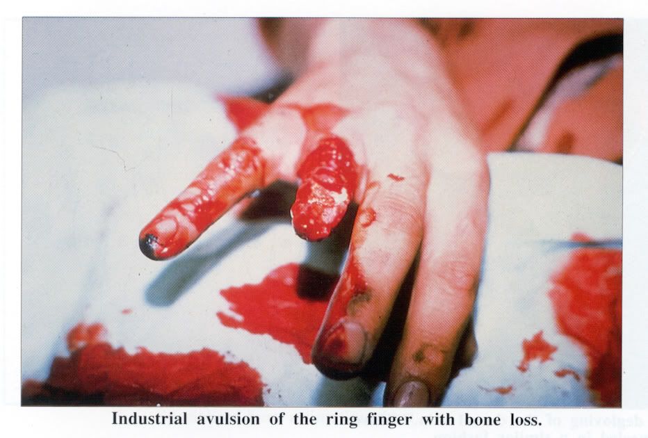 Avulsion Wound