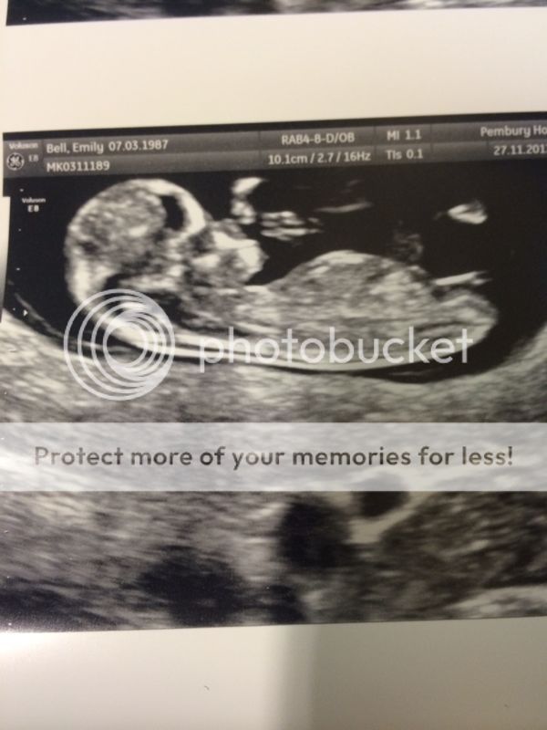 Anyone had a gender scan with a forked nub? BabyCenter